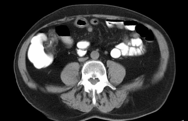 Ileitis terminalis et präterminalis, trans., CT, 66 J., männlich